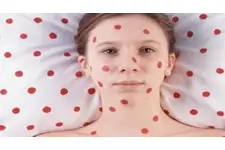 Büyüklerde Su Çiçeği Hastalığı Belirtileri ve Tedavisi