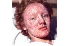 Çiçek Hastalığı Belirtileri ve Tedavisi Çiçek Hastalığı Belirtileri ve Tedavisi