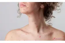 Hamilelikte Çiçek Hastalığı Belirtileri ve Tedavisi Hamilelikte Çiçek Hastalığı Belirtileri ve Tedavisi