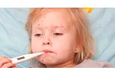 Su Çiçeği Hastalığı Nedir? Su Çiçeği Hastalığı Nedir?