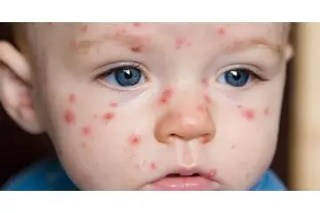 Su Çiçeği Hastalığı Nasıl Bulaşır?