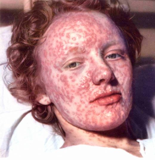 Çiçek Hastalığı Belirtileri ve Tedavisi