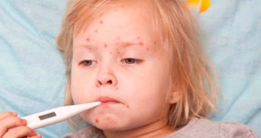 Çiçek Hastalığı Nasıl Geçer?