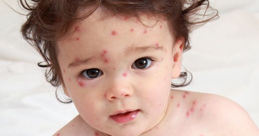 Çiçek Hastalığı Nedir?